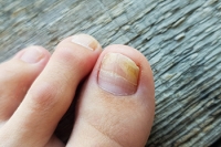 Causes and Symptoms of Onychomycosis