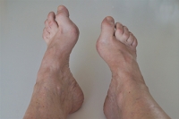 Problems Caused by High Arches